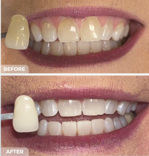 White Enhancement